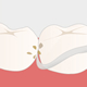 フェニックス歯科の歯石除去
