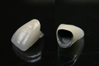 フェニックス歯科のメタルボンド