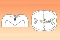 フェニックス歯科のシーラントのイメージ図